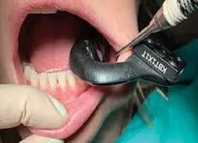 چه عواملی باعث عفونت ایمپلنت دندان می گردد